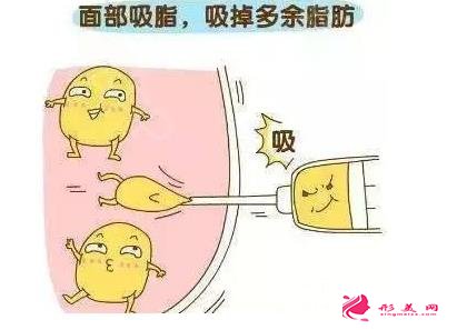 面部吸脂恢復(fù)期
