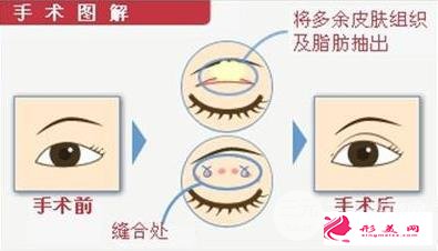 腫眼泡的福星：眼皮抽脂術(shù)效果好不好~