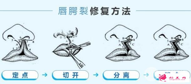 科普：兔唇手術(shù)多少錢？