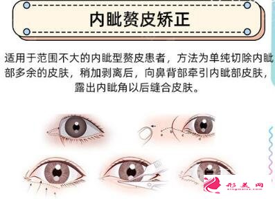 做開眼角手術多少錢？貧民窟女孩也能HOLD住