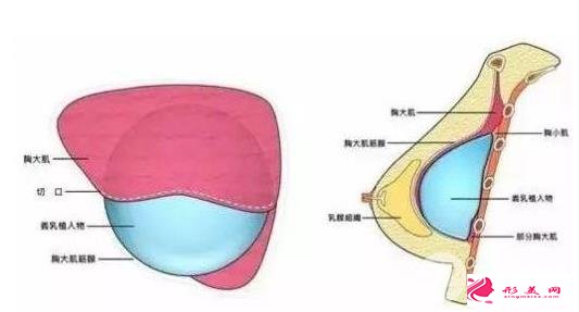 進(jìn)口假體隆胸品牌有哪些？看完科普你就知道了~