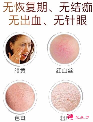 醫(yī)美小課堂：白瓷娃娃激光功效及效果圖