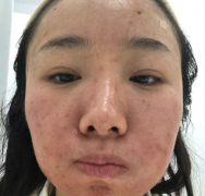 成都華西醫(yī)院激光美容科價(jià)格表，附祛斑案例