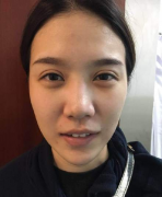 北京八大處李發(fā)成脂肪填充全臉 仙女效果圖曝光！