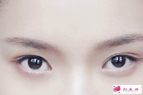 開(kāi)眼角后出現(xiàn)疤痕增生的情況怎么解決