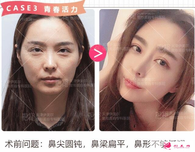 硅膠隆鼻效果圖