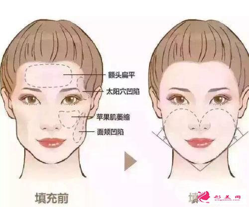 玻尿酸豐面頰多少錢？揮別凹陷，還你年輕臉蛋~