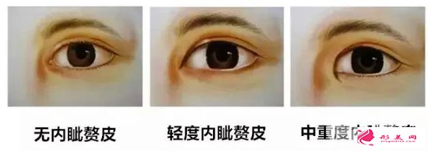 開外眼角的價(jià)格