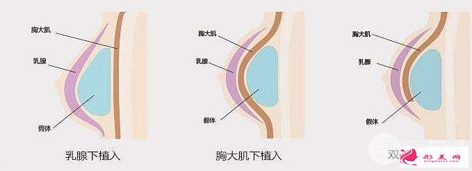 胸部整形手術(shù)多少錢？受三方面因素的影響~