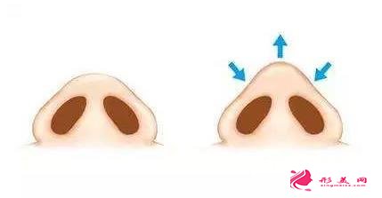 鼻頭縮小術需要多少錢？