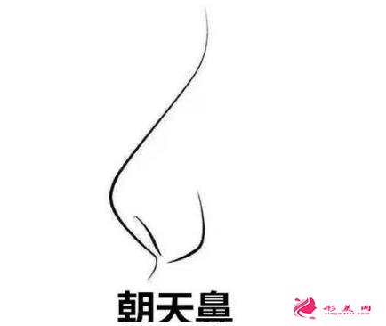 朝天鼻矯正要多少錢？