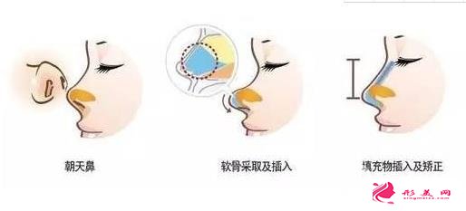 朝天鼻矯正要多少錢？
