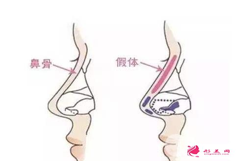 假體隆鼻怎么樣?