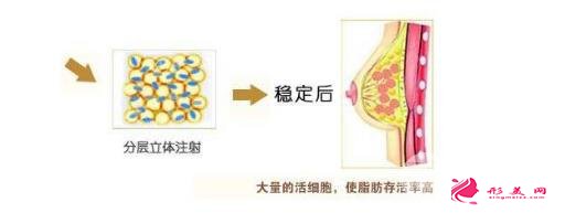 自體脂肪移植隆胸費用