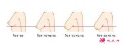 乳房下垂矯正方法有幾種？