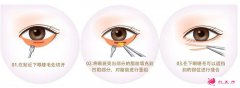 眼袋抽脂一周后能化妝嗎？