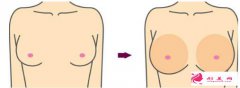 乳房下垂矯正術(shù)的價(jià)格是多少？