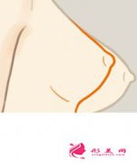 巨乳縮小手術會不會反彈回來呢？
