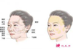 自體脂肪填充為何這么火?