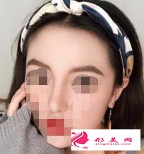 醫(yī)生做的肋軟骨隆鼻效果如何，進(jìn)來瞧瞧吧