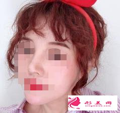醫(yī)生做的肋軟骨隆鼻效果如何，進(jìn)來瞧瞧吧