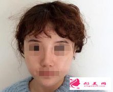 肋軟骨隆鼻效果如何？來(lái)看看效果吧