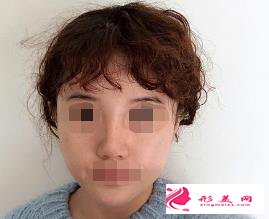 醫(yī)生做的肋軟骨隆鼻效果如何，進(jìn)來瞧瞧吧