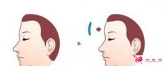 北京額部填充的價(jià)格是多少？