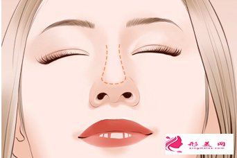 棗莊礦務(wù)局醫(yī)院歪鼻矯正手術(shù)讓鼻子更立體