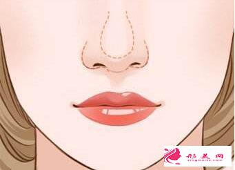 鼻翼縮小效果完全呈現(xiàn)的時(shí)間