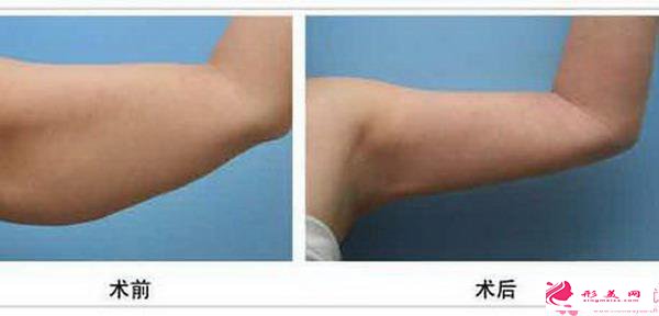 影響手臂吸脂手術(shù)價格的因素有哪些？