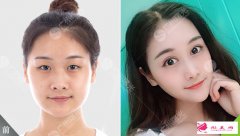  廣州曙光醫(yī)學(xué)美容醫(yī)院怎么樣？眼綜合案例分享