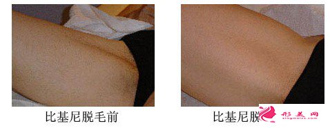 湖南韓美激光比基尼脫毛的效果體現在那