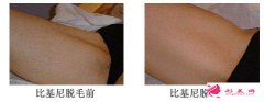 激光比基尼脫毛的效果體現(xiàn)在那？