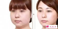 溶脂針瘦臉有什么優(yōu)勢呢？