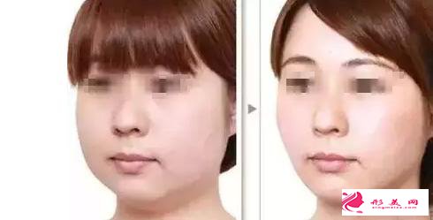 湖南韓美溶脂針瘦臉有什么優(yōu)勢(shì)呢