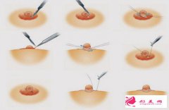 乳暈縮小術(shù)效果明顯嗎？