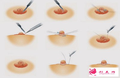 乳暈縮小術(shù)效果明顯嗎