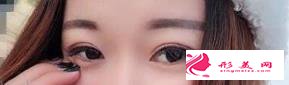 雙眼皮手術(shù)后給了我一雙靈動(dòng)的雙眼