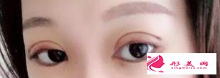 雙眼皮手術(shù)后給了我一雙靈動(dòng)的雙眼