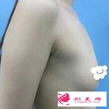 隆胸讓我能夠深深吸引著異性的目光