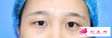 眼綜合拯救了我的正泡眼，選擇醫(yī)生是關(guān)鍵