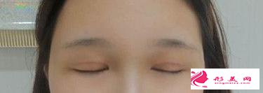 眼綜合拯救了我的正泡眼，選擇醫(yī)生是關(guān)鍵