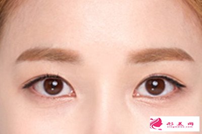 開(kāi)眼角是什么手術(shù)原理