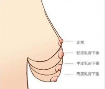怎么判斷乳房下垂的程度是否嚴重？