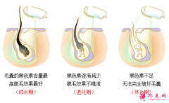 激光脫毛對皮膚有損傷嗎？