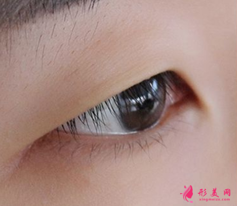 腫泡眼可不可以割雙眼皮