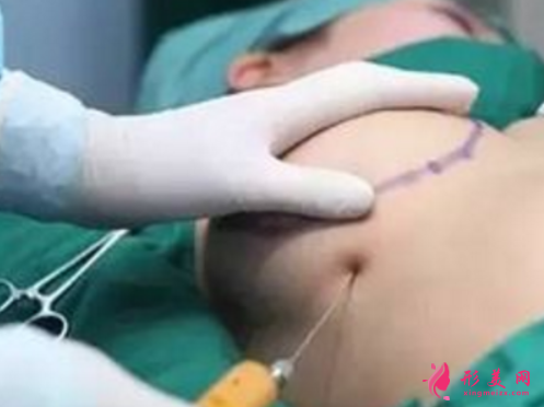 用自身脂肪隆胸價格是多少