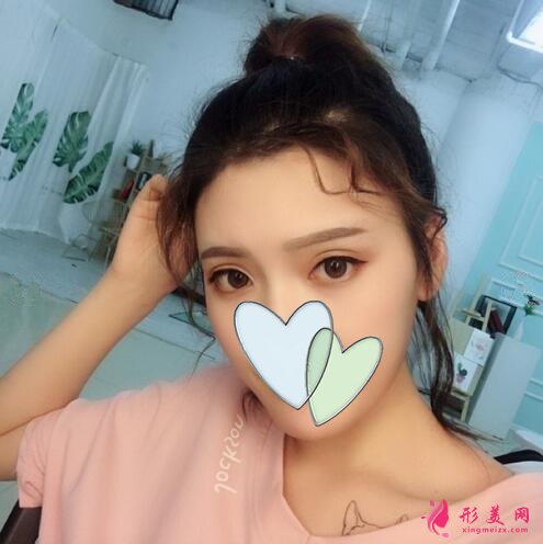 深圳美麗方案醫(yī)療美容姚堯自體脂肪填充心形臉案例