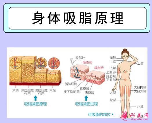 背部吸脂手術(shù)痛嗎?